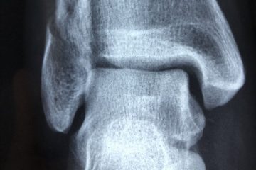 Radiografia caviglia
